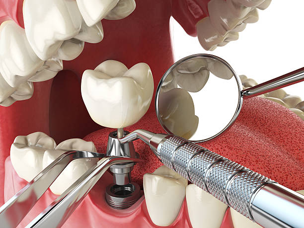 Best Broken Tooth Emergency  in Rosepine, LA