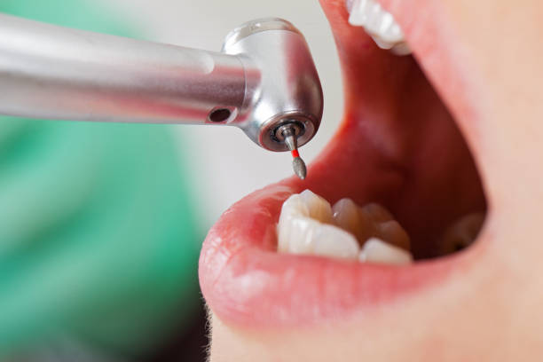 Best Urgent Tooth Repair  in Rosepine, LA